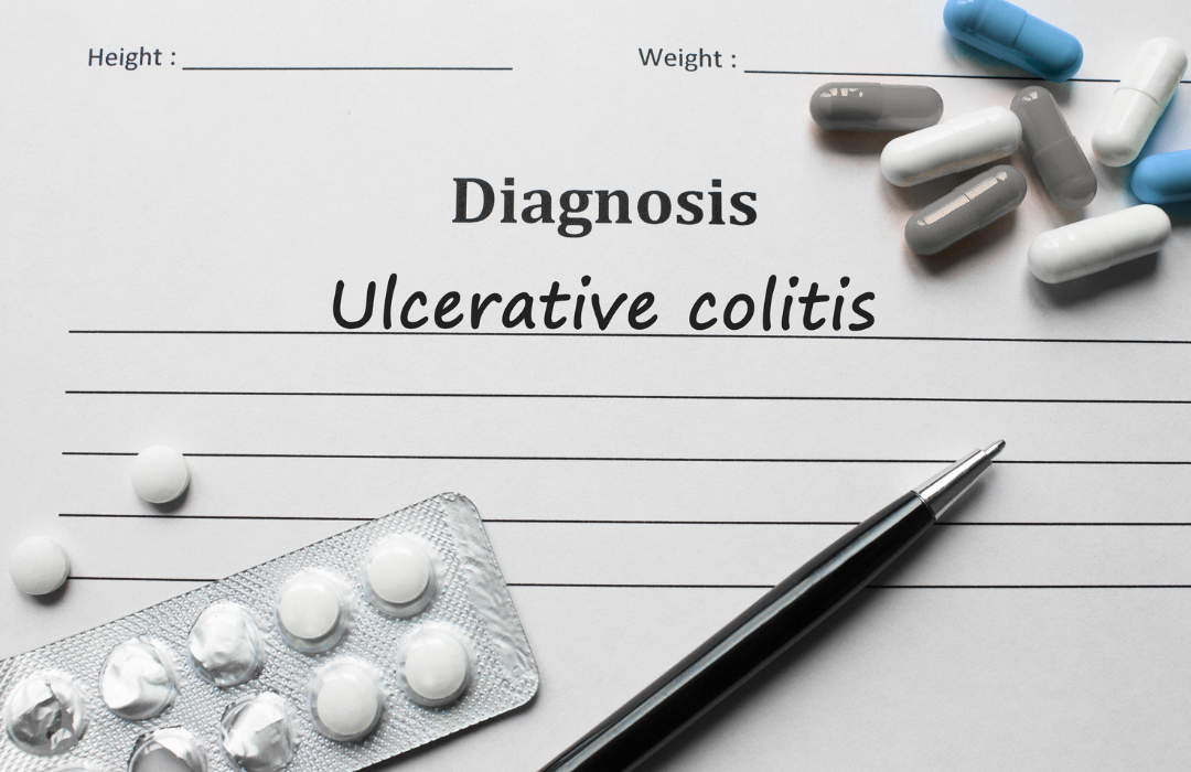 Bolesti-probavnog-sustava-Ulcerozni-kolitis