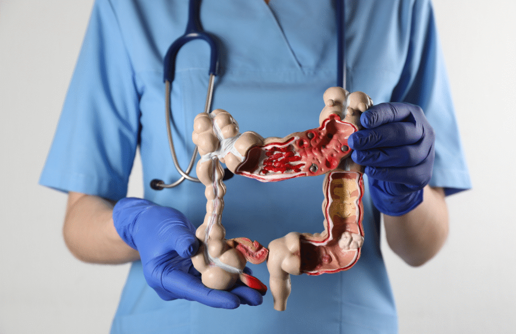 Bolesti probavnog sustava-Crohnova bolest-terapija